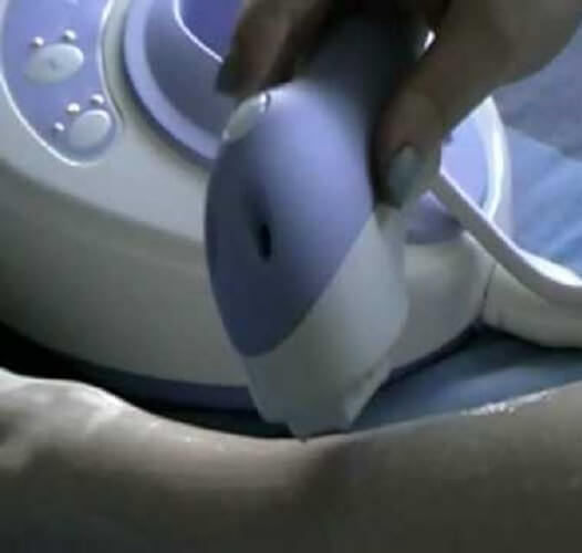 Boots Smooth Skin iPulse Hair Removal Device, Intense Pulsed Light Permanent Hair Reduction System - (Amazon Container Product as it is, No Warranty, No Guarantee, No Return, No Exchange) - Imported from UK