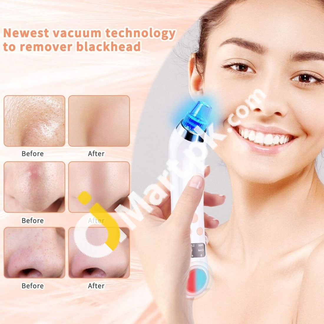 Blackhead Remover Usb Rechargeable Vacuum Pore Professional Cleaner With 5 Adjustable Suction Power