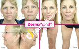Dermawand Anti-Aging Device Reduce The Appearance Of Fine Lines & Wrinkles - Imported From Uk
