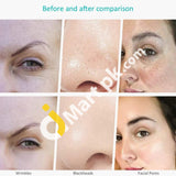 Kinga Skin Scrubber Facial Spatula For Cleansing & Blackhead Remover - Imported From Uk