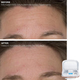 Trophy Skin MicrodermMD Professional Kit At-Home - Anti Aging, Acne Scars Treatment & Exfoliation - Contains Real Diamond and Pore Extractor Tips to Rejuvenate Skin in Pakistan